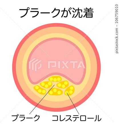 動脈硬化導致斑塊變窄的血管縱切面圖示 106759010