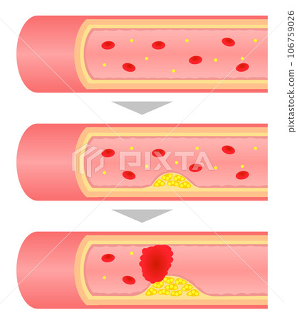 Illustration of a cross-sectional view of progressing arteriosclerosis 106759026