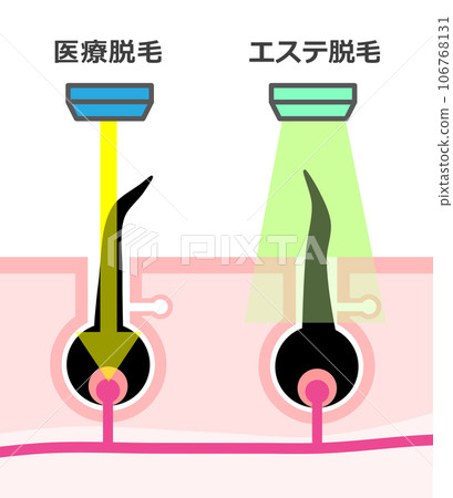 Illustration explaining the difference between aesthetic hair removal and medical hair removal used for hair removal Illustration explaining the difference between aesthetic hair removal and medical hair removal used for hair removal 106768131