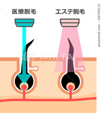 Illustration explaining the difference between aesthetic hair removal and medical hair removal used for hair removal Illustration explaining the difference between aesthetic hair removal and medical hair removal used for hair removal 106768132