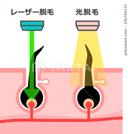 Illustration explaining the difference between aesthetic hair removal and medical hair removal used for hair removal 106768133