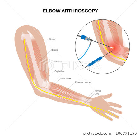 Elbow arthroscopy surgery Elbow arthroscopy surgery 106771159