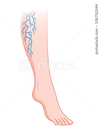 Varicose veins. Blue blood vessel visible through the skin, abnormally swollen leg. Vascular disease diagnostic and treatment. Venous insufficiency medical disease Varicose veins. Blue blood vessel visible through the skin, abnormally swollen leg. Vascular disease diagnostic and treatment. Venous insufficiency medical disease 106782044