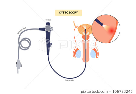Cystoscopy examination concept 106783245