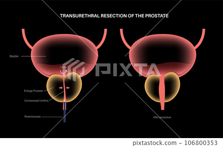 Transurethral resection of the prostate Transurethral resection of the prostate 106800353