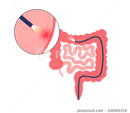 Colonoscopy medical procedure 106800356