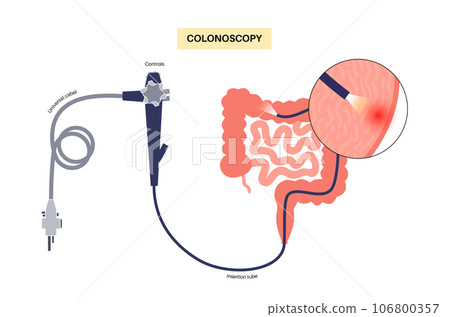 Colonoscopy medical procedure 106800357
