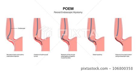 POEM medical poster 106800358