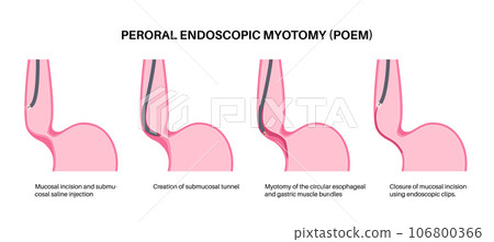 POEM medical poster POEM medical poster 106800366