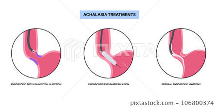 Achalasia treatments procedures Achalasia treatments procedures 106800374
