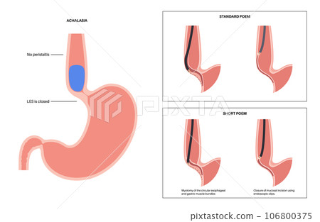 POEM medical poster 106800375