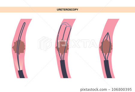 Ureteroscopy medical poster 106800395