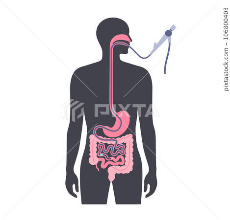 Balloon assisted enteroscopy 106800403