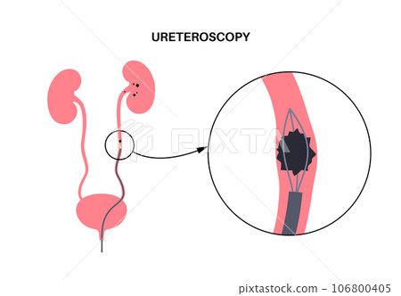 Ureteroscopy medical poster Ureteroscopy medical poster 106800405