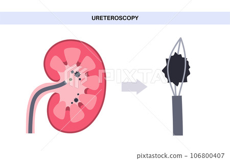 Ureteroscopy medical poster 106800407