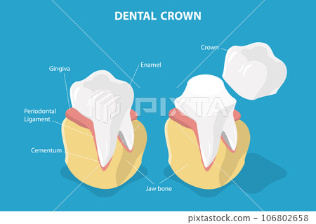 3D Isometric Flat Vector Conceptual Illustration of Dental Crown Restoration 106802658