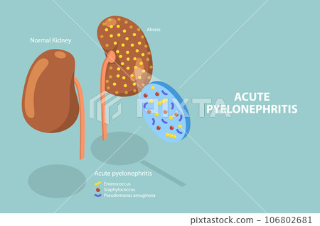 3D Isometric Flat Vector Conceptual Illustration of Acute Pyelonephritis 3D Isometric Flat Vector Conceptual Illustration of Acute Pyelonephritis 106802681