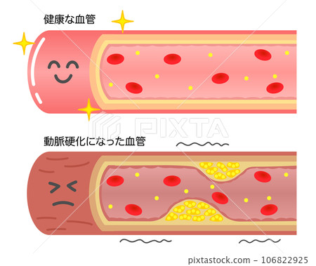 Comparison illustration of healthy blood vessels and blood vessels narrowed due to arteriosclerosis Comparison illustration of healthy blood vessels and blood vessels narrowed due to arteriosclerosis 106822925