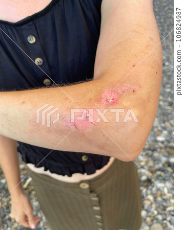 Woman with a scar on her arm after car accident Woman with a scar on her arm after car accident 106824987