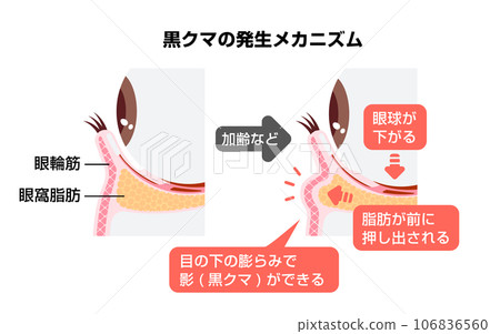 Causes of dark circles (lower eyelid cross-sectional view illustration) 106836560