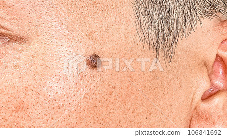 一個有痣的男人的特寫 106841692