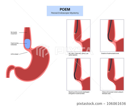 POEM medical poster 106861636