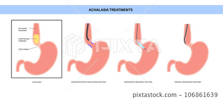 Achalasia treatments procedures 106861639