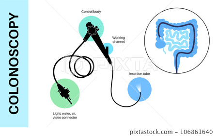 Colonoscopy medical procedure Colonoscopy medical procedure 106861640