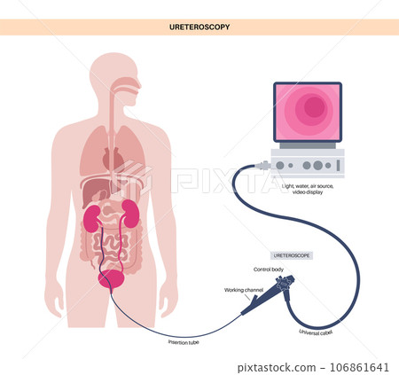 Ureteroscopy medical poster 106861641