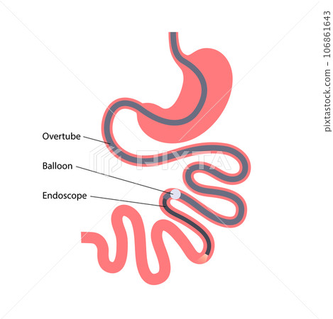 Single balloon enteroscopy 106861643
