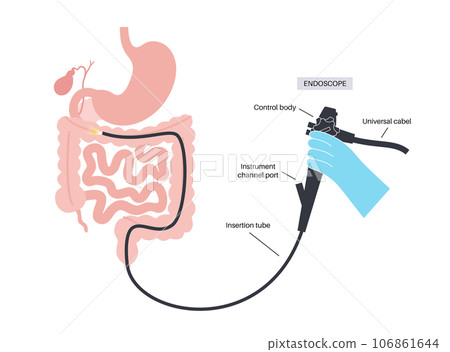 Colonoscopy medical procedure Colonoscopy medical procedure 106861644