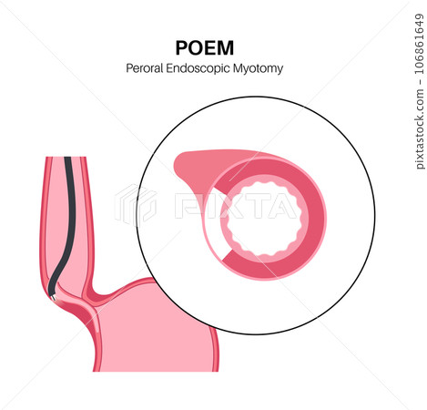 POEM medical poster POEM medical poster 106861649
