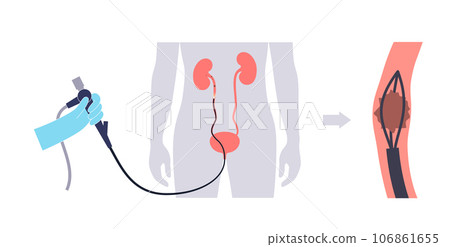 Ureteroscopy medical poster Ureteroscopy medical poster 106861655