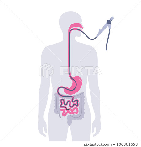 Esophagogastroduodenoscopy medical procedure 106861658