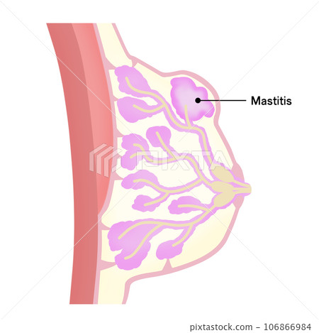 乳腺炎的插圖 106866984