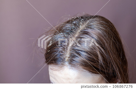 Parting of women's hair on the head. Hair care and care. Closeup of a woman's head with parted gray hair regrown roots becouse of quarantine Parting of women's hair on the head. Hair care and care. Closeup of a woman's head with parted gray hair regrown roots becouse of quarantine 106867276