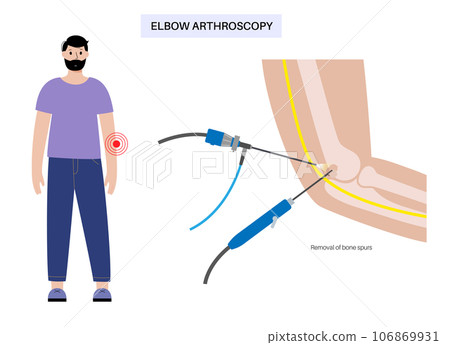 Bone spurs of elbow 106869931