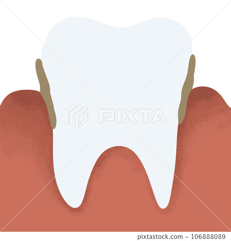 Tartar and bactrail tooth plaque, lower jaw. Medically accurate  illustration of human teeth treatment 106888089