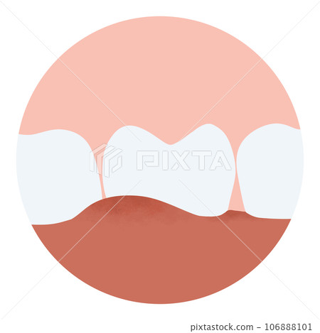Tartar and bactrail tooth plaque, lower jaw. Medically accurate  illustration of human teeth treatment 106888101