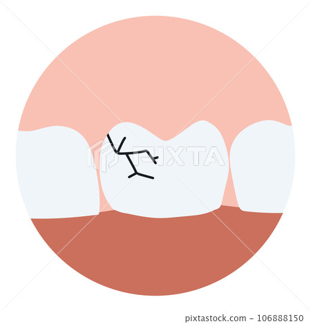 Cracked tooth, splitted. Medically accurate  illustration 106888150