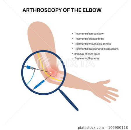 Elbow arthroscopy surgery 106900118