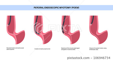 POEM medical poster 106946734