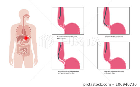 POEM medical poster POEM medical poster 106946736