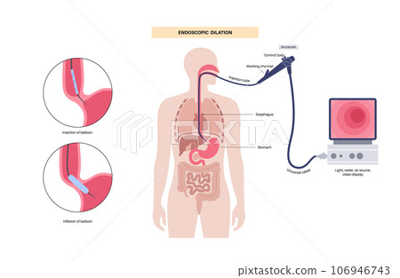 Endoscopic pneumatic dilation Endoscopic pneumatic dilation 106946743