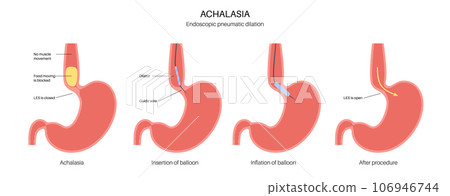 Endoscopic pneumatic dilation 106946744