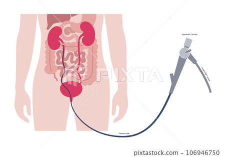 Ureteroscopy medical poster 106946750