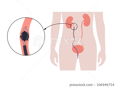 Ureteroscopy medical poster Ureteroscopy medical poster 106946754
