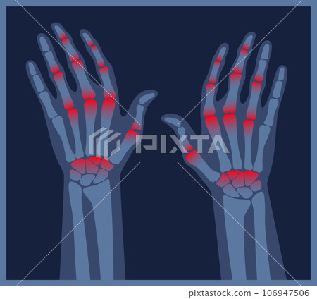 Arthritis hands x-ray. Pain in the human body. Arthritis, bone disease medical poster. Finger arthritis vector illustration. Chronic skeleton pain, inflammation and autoimmune disorder Arthritis hands x-ray. Pain in the human body. Arthritis, bone disease medical poster. Finger arthritis vector illustration. Chronic skeleton pain, inflammation and autoimmune disorder 106947506