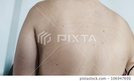 a mark from a woman's bra on the shoulders a mark from a woman's bra on the shoulders 106947698