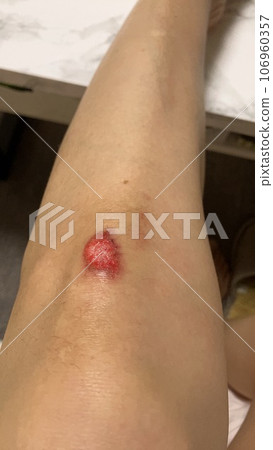 膝蓋受傷 106960357